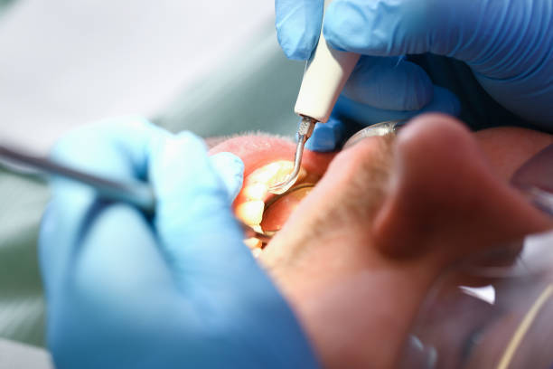 Best Emergency Root Canal Treatment in Texarkana, TX